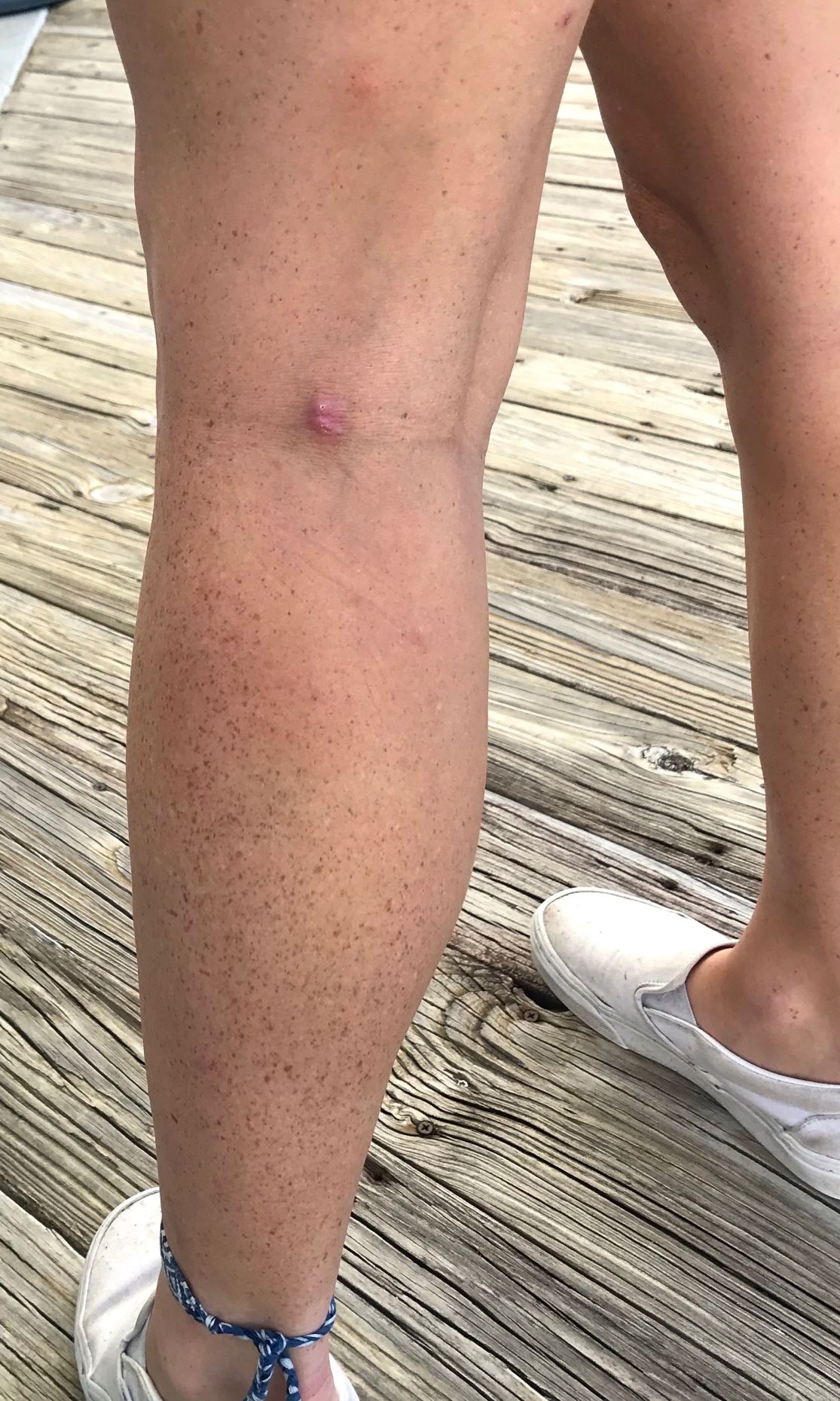 Scar from raccoon attack on student